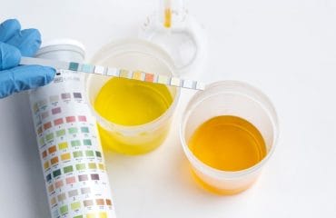 perbedaan warna urine normal dan abnormal