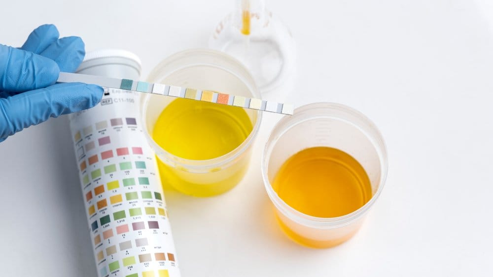 perbedaan warna urine normal dan abnormal