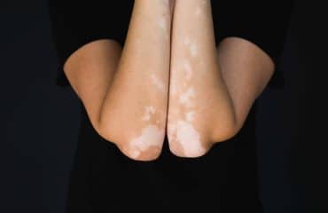 Mengenal Vitiligo: Penyebab hingga Pengobatannya