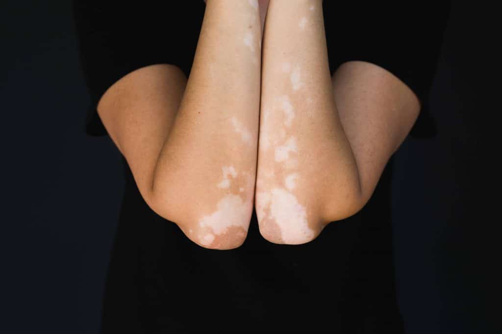 Mengenal Vitiligo: Penyebab hingga Pengobatannya