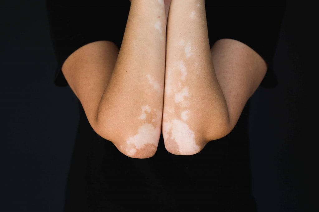 Vitiligo Kenali Gejala