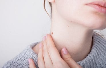 Kanker Kulit Melanoma