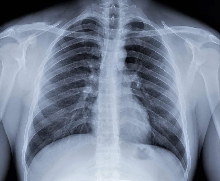 Hasil Rontgen Covid-19 