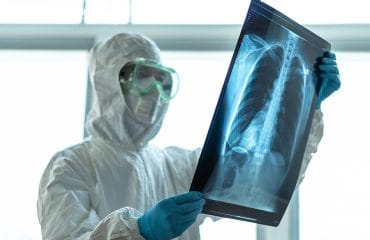 Hasil Rontgen Covid-19