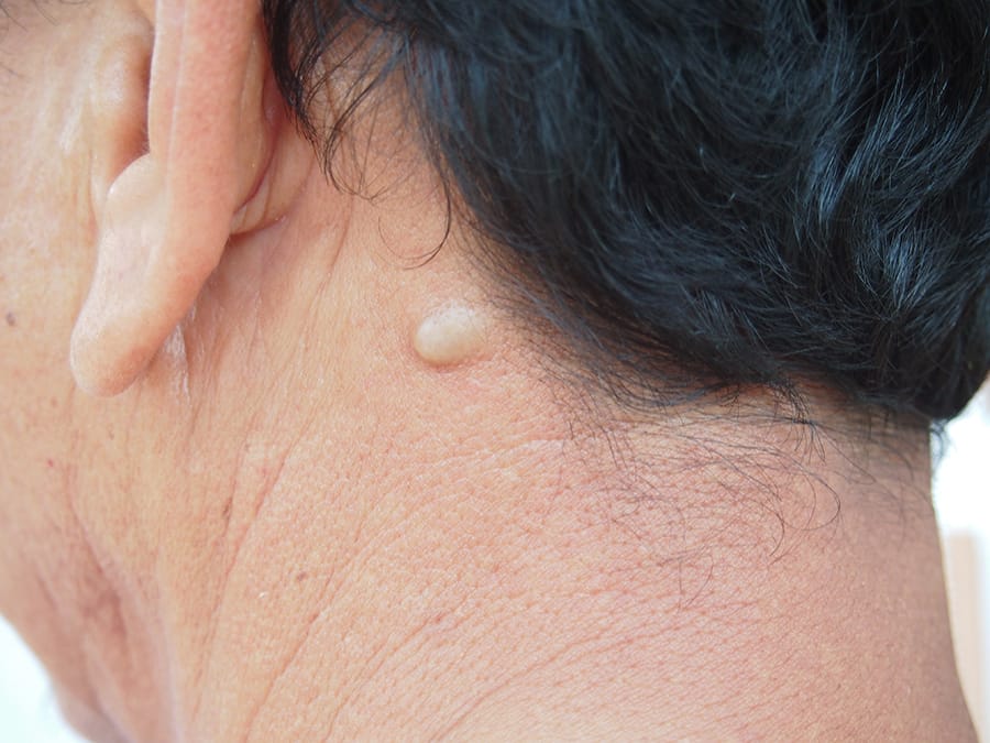 Kista epidermoid adalah