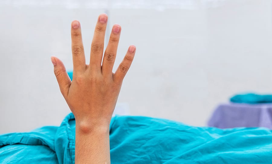 Bahaya Kista Ganglion yang Perlu Diketahui