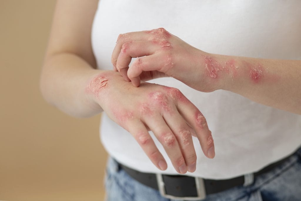 Berapa Lama Herpes Sembuh Total? Cek Pengobatannya