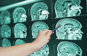 cedera otak traumatik