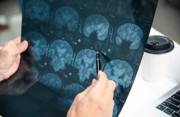 cedera otak traumatik