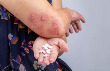 cara mengobati cacar ular