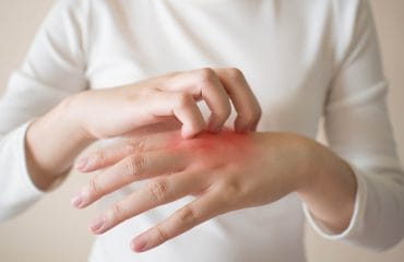 Cara Mengobati Eksim