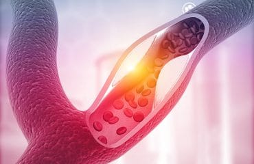 Gangguan Aterosklerosis Terjadi Jika Darah Mengandung Kelebihan