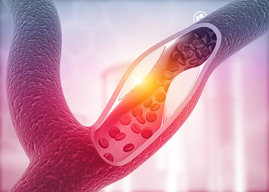 gangguan aterosklerosis terjadi jika darah mengandung kelebihan