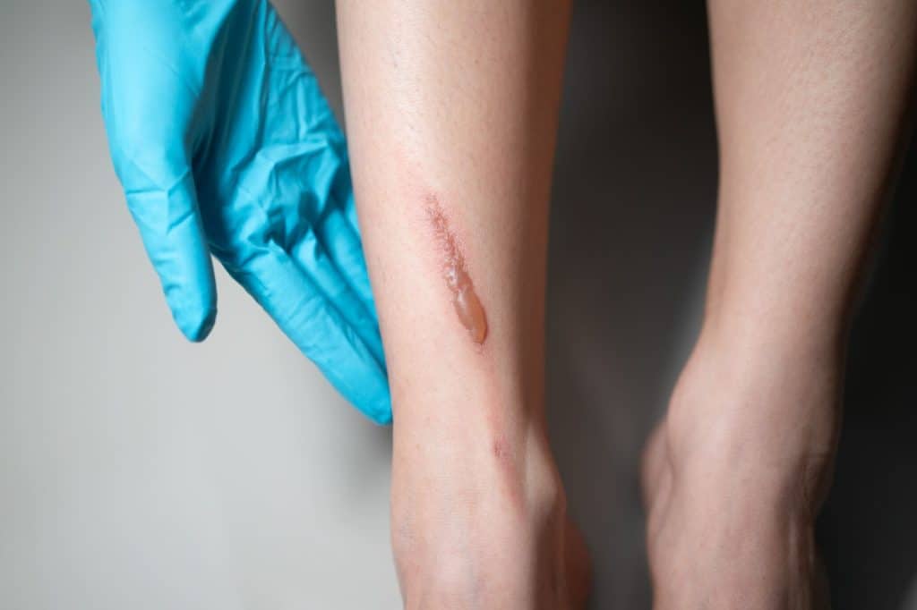 Penyebab kulit melepuh