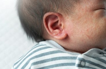 Bagaimanakah Cara Mencegah Terjadinya Penyakit Biang Keringat