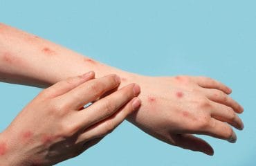 ruam gejala cacar monyet