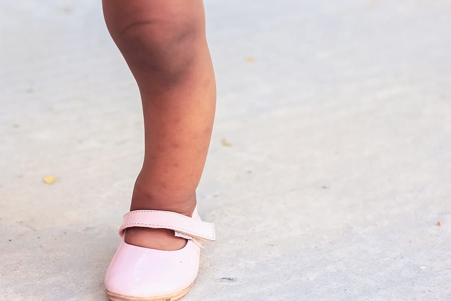 Bagaimana Cara Pencegahan Penyakit Rakitis