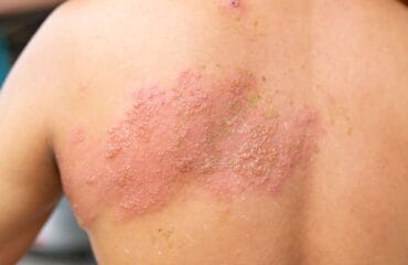 jenis herpes