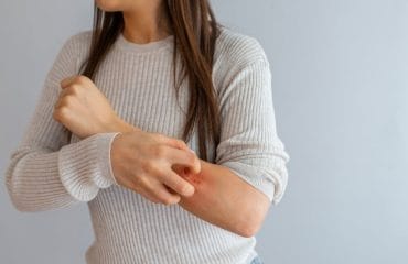 Alergi Dingin: Gejala, Penyebab, dan Pengobatan