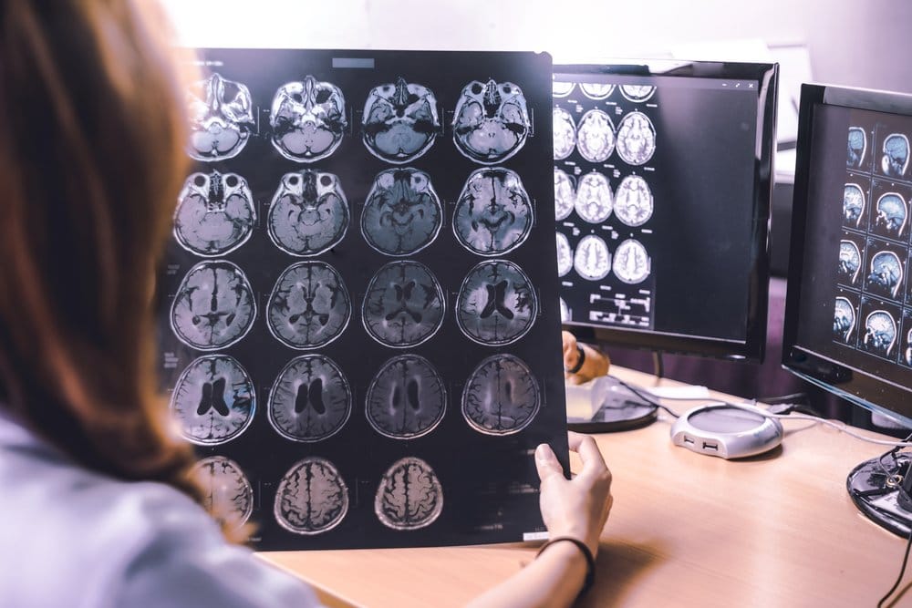 Mati Batang Otak: Tanda dan Diagnosis yang Tepat