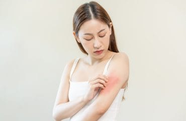 3 Perbedaan Kudis dan Kurap yang Jarang Diketahui