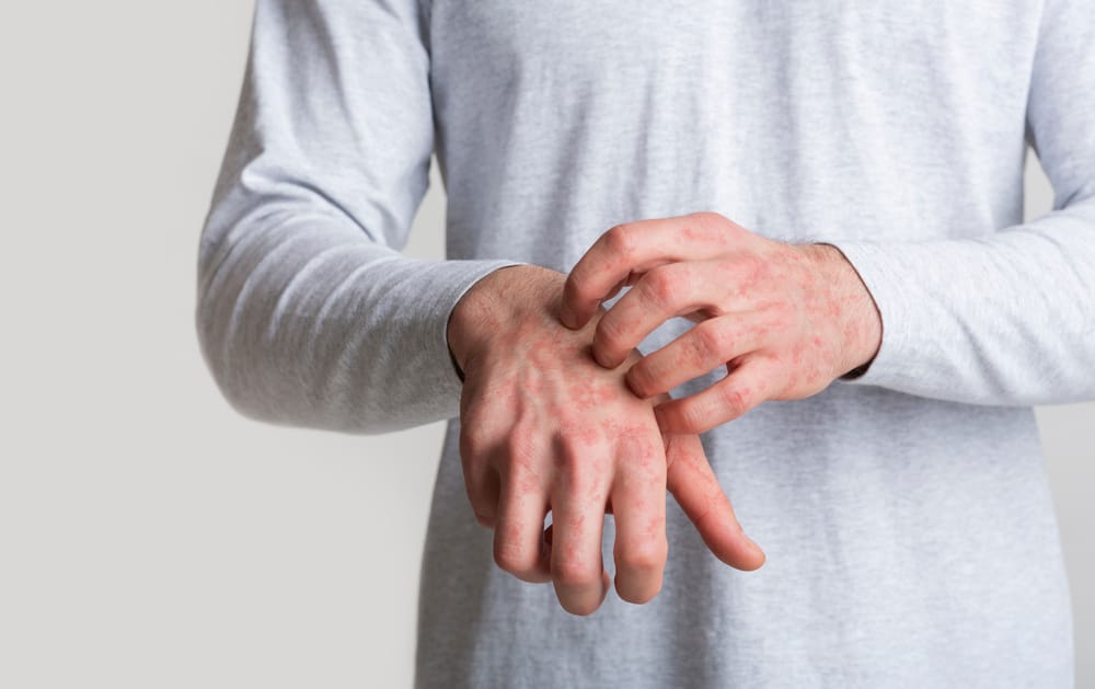 Perbedaan Herpes dan Tomcat