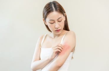 5 Jenis Infeksi Jamur Kulit yang Umum Terjadi dan Pengobatannya