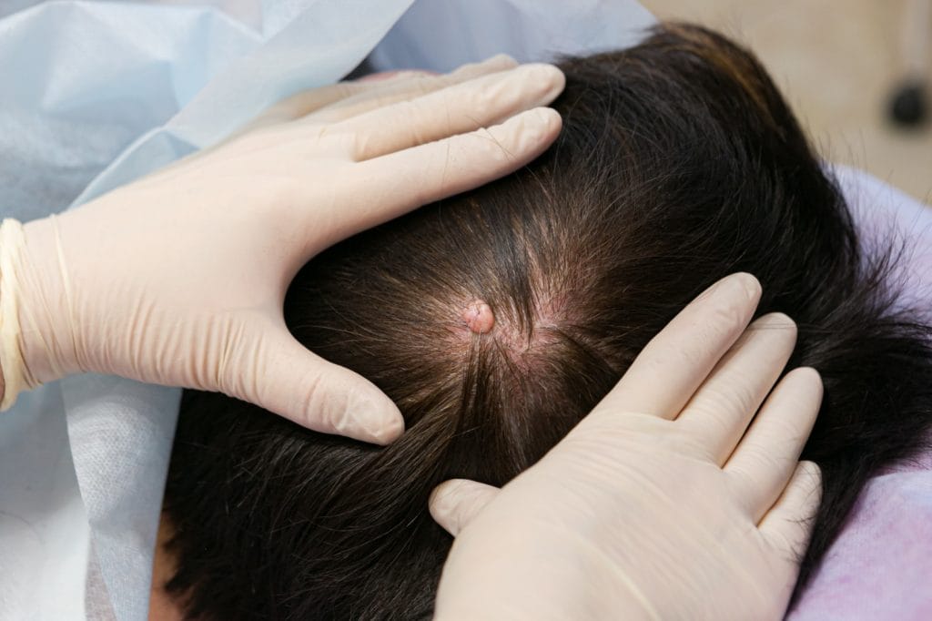 gambar bisul di kulit kepala