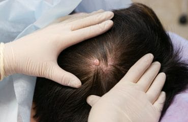 gambar bisul di kulit kepala