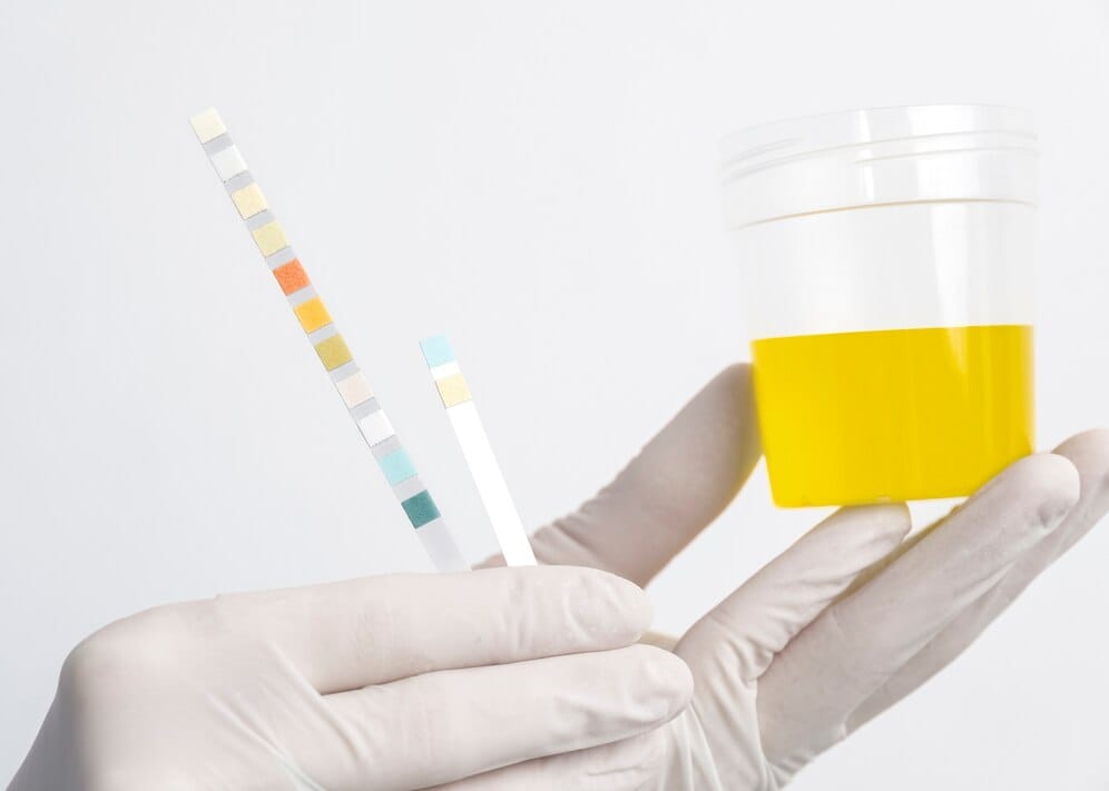 warna urine normal adalah kuning pucat