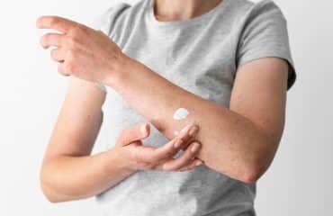 cara menghilangkan gatal secara alami dan cepat