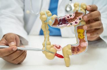 Gejala Radang Usus Buntu