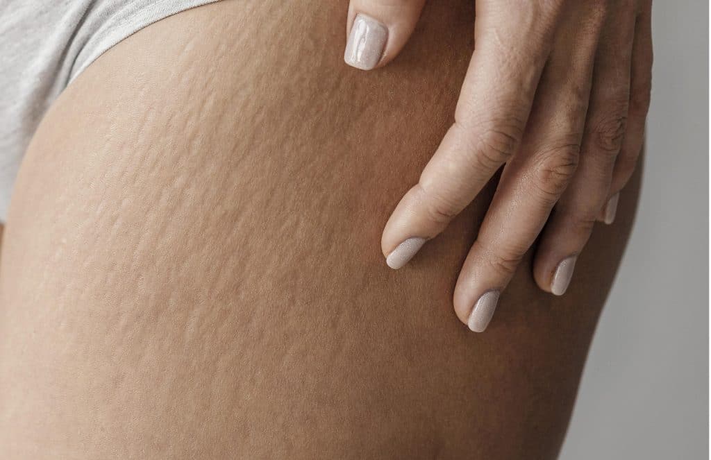 Stretch Mark di Paha
