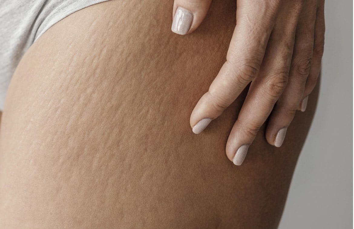 Stretch Mark di Paha
