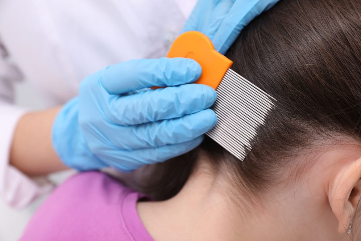 cara menghilangkan kutu rambut