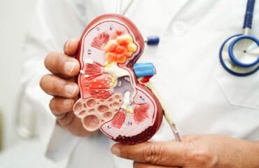 penyebab kanker ginjal