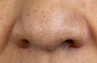 komedo di hidung