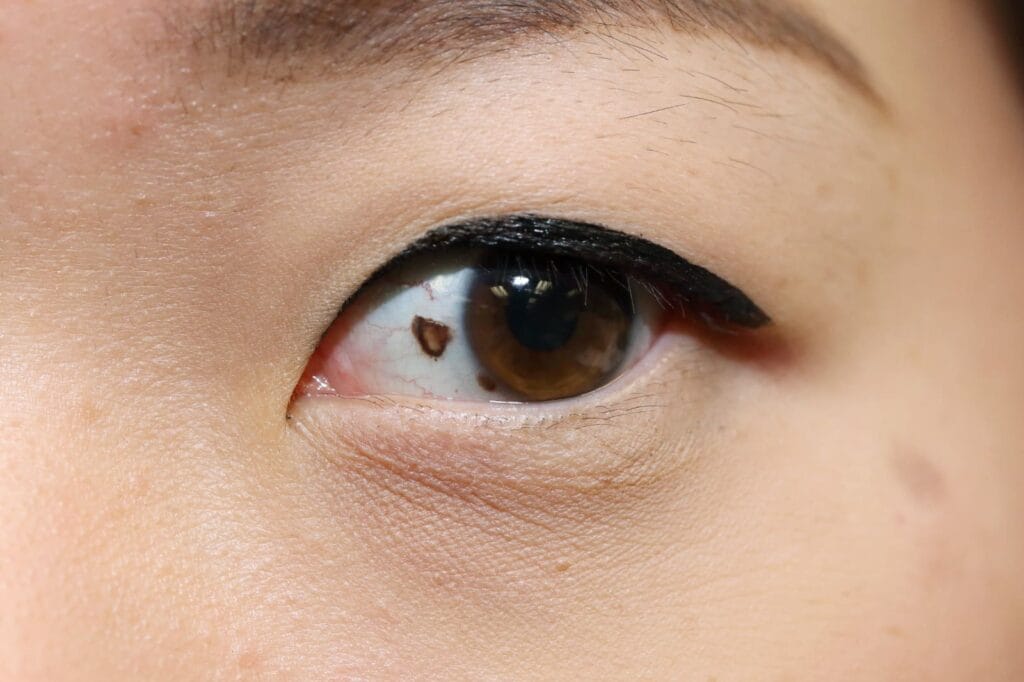 kanker mata melanoma