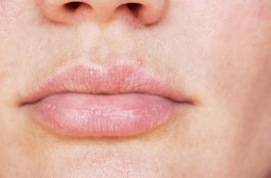 penyebab bintik putih pada bibir