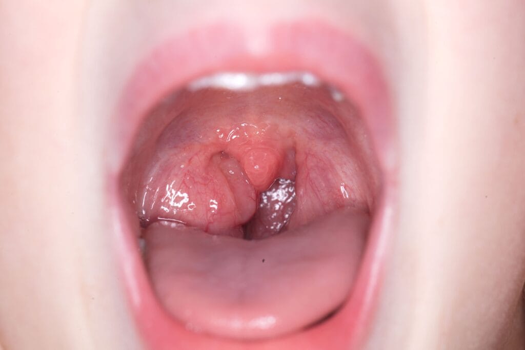 Cara mengobati amandel tanpa operasi