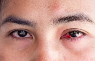 penyebab pembuluh darah pecah