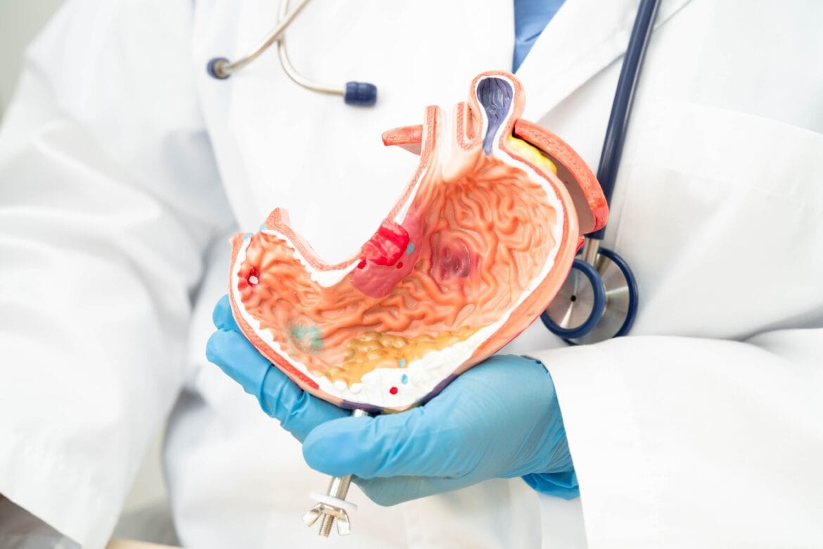 penyebab kanker lambung