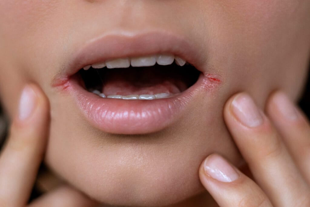 herpes di bibir