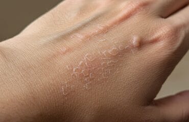 penyebab kulit bersisik