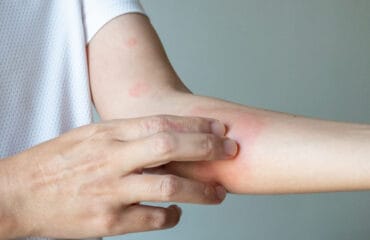 pertolongan pertama alergi