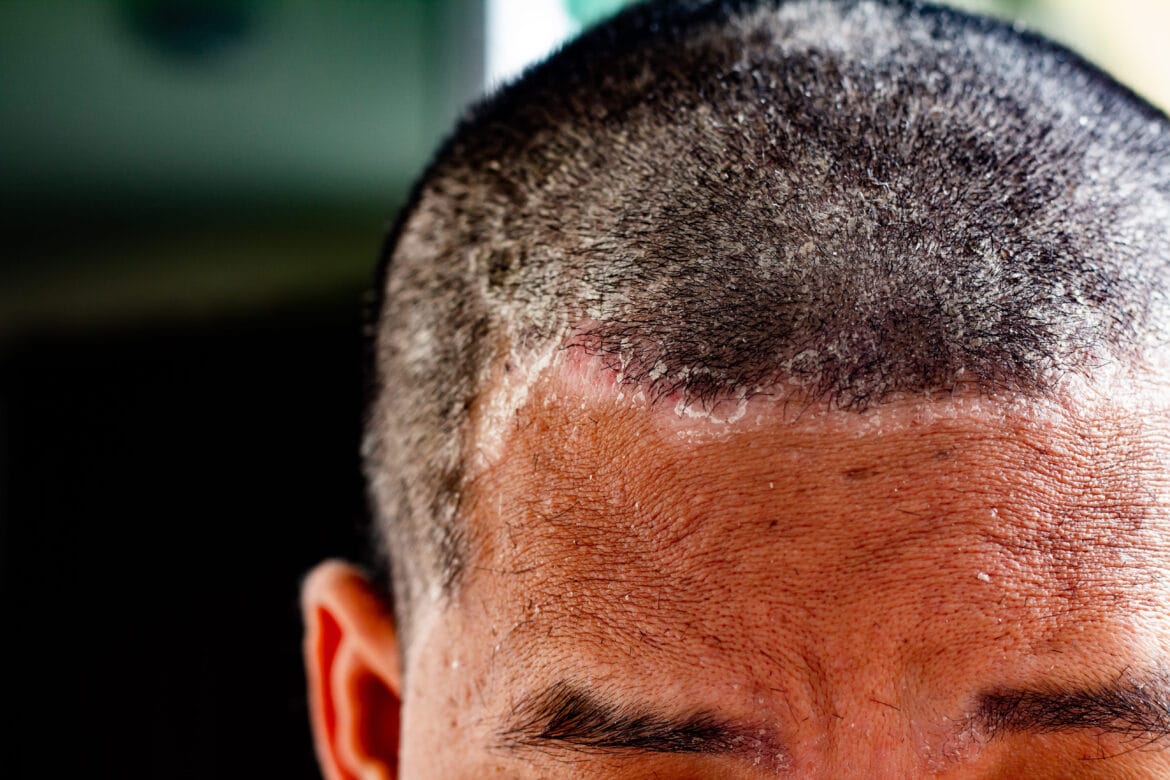 Tinea Capitis adalah